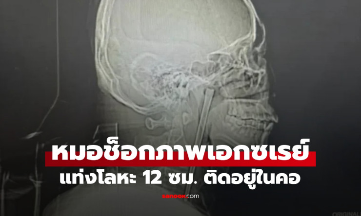 ช็อกสุดขีด! ตะเกียบโลหะยาว 12 ซม. ฝังคอผู้ชายจีนนาน 8 ปี ทีมหมออ้าปากค้าง - betfahvip