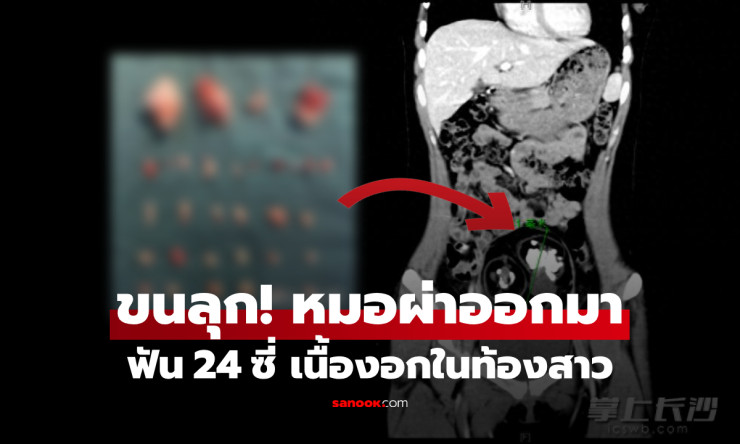 ช็อกสุดขีด! สาว 18 ผ่าท้องเจอฟัน 24 ซี่ในเนื้องอก หมออึ้งหนัก ไม่ใช่ผีไสย แต่เป็นโรคสยองแบบนี้! - betfahvip