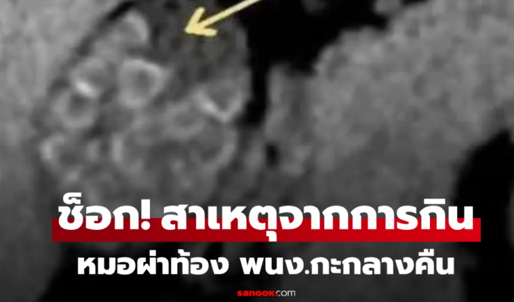 ผ่าท้องหญิง พนักงานกะดึก แพทย์สะพรึง เหมือนเปิดกล่องสุ่มคริสตัล ขนลุกสาเหตุจากการกิน!!! - betfahvip